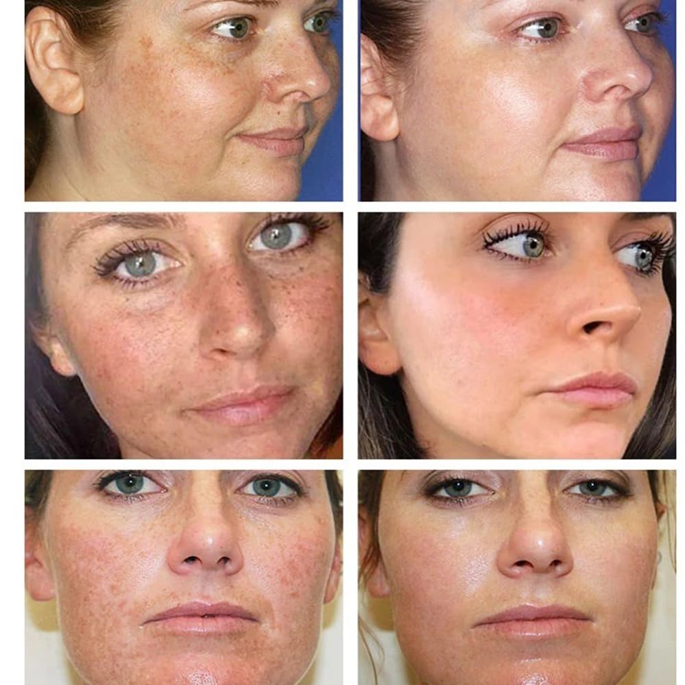Whitening Facial Cream, Lightening and Freckle-Removing Cream - 20g