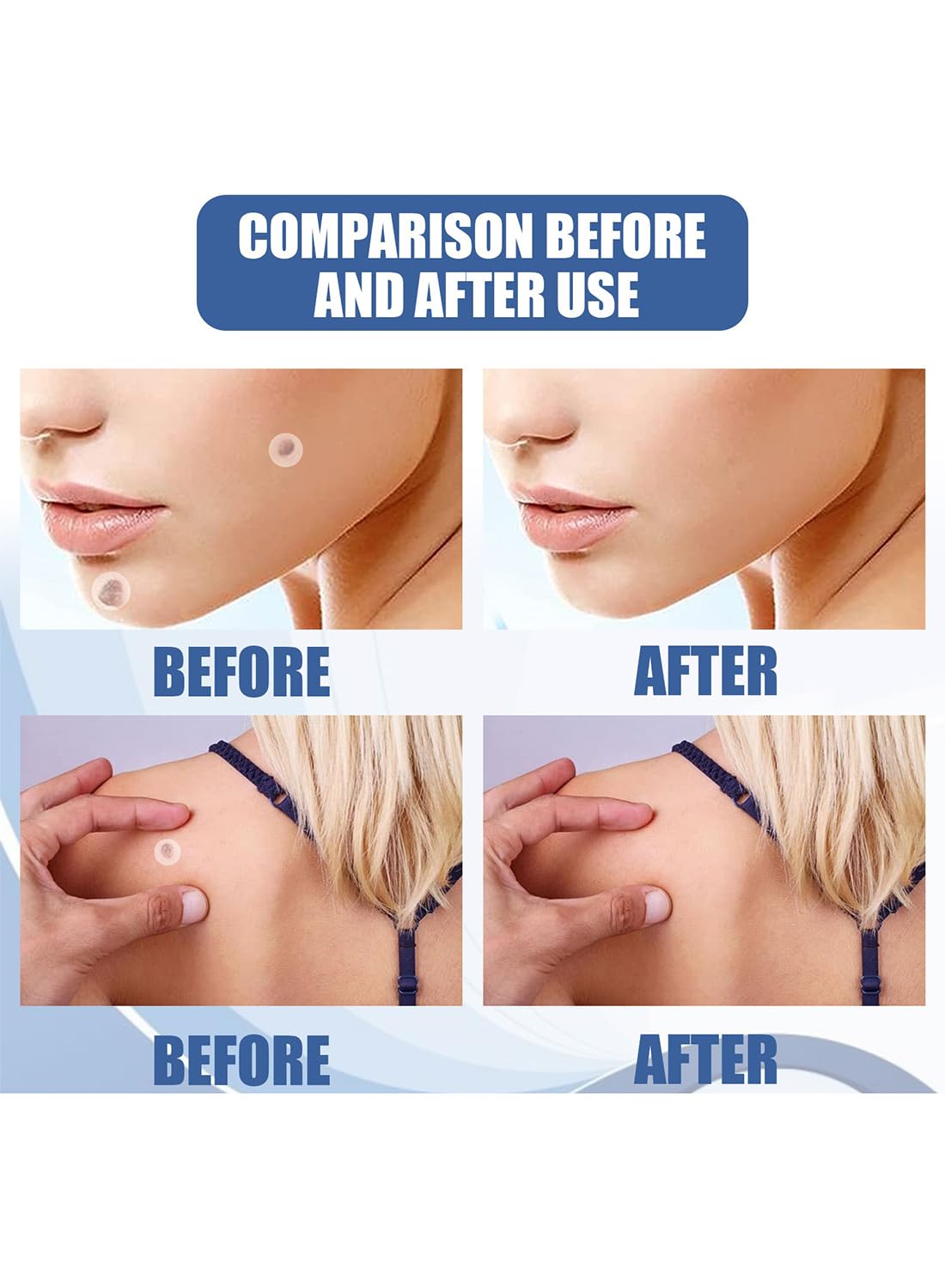 144Pcs Wart and Mole Remover, Easy-to-Use Waterproof Transparent Stickers