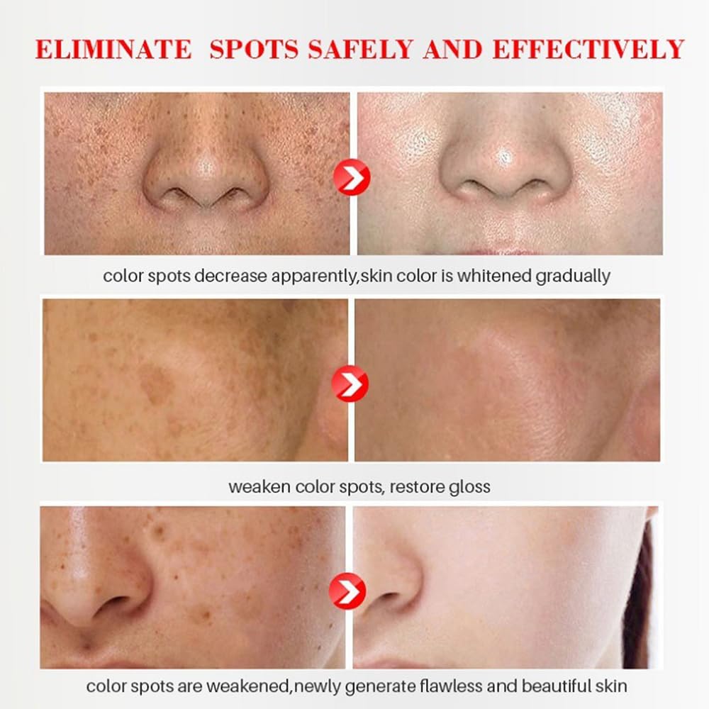 Whitening Facial Cream, Lightening and Freckle-Removing Cream - 20g