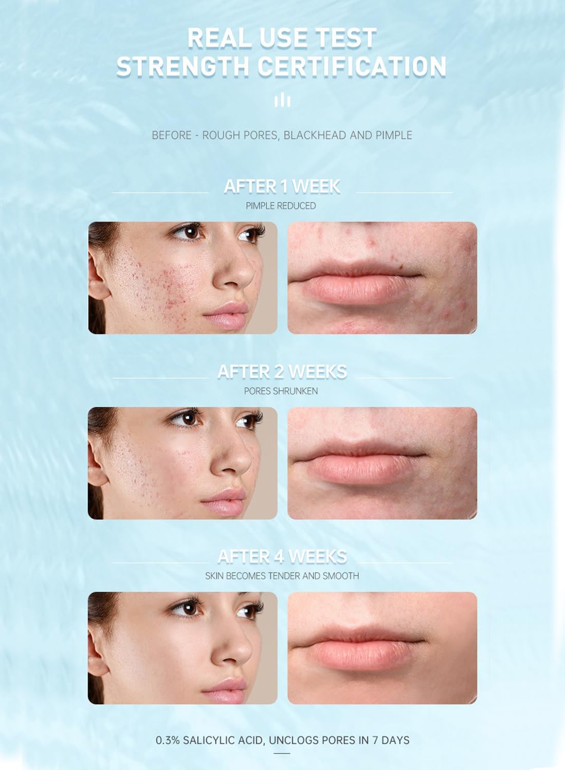0.3% Salicylic Acid Cream, Face Lotion Preventing Breakouts for Acne Skin - 15ml