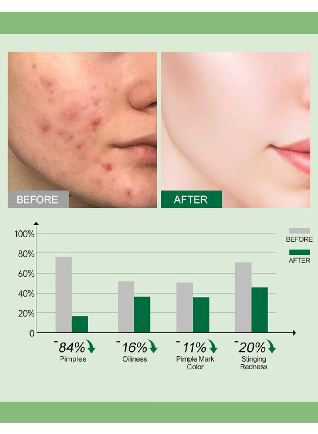 Acne Treatment Face Cream with Tea Tree Oil & Vitamin B3, Inflammation Soothing Acne Moisturizer, Acne Remover for Stubborn Pimple Blackhead Whitehead Blemish, Shrink Enlarged Pores 50g