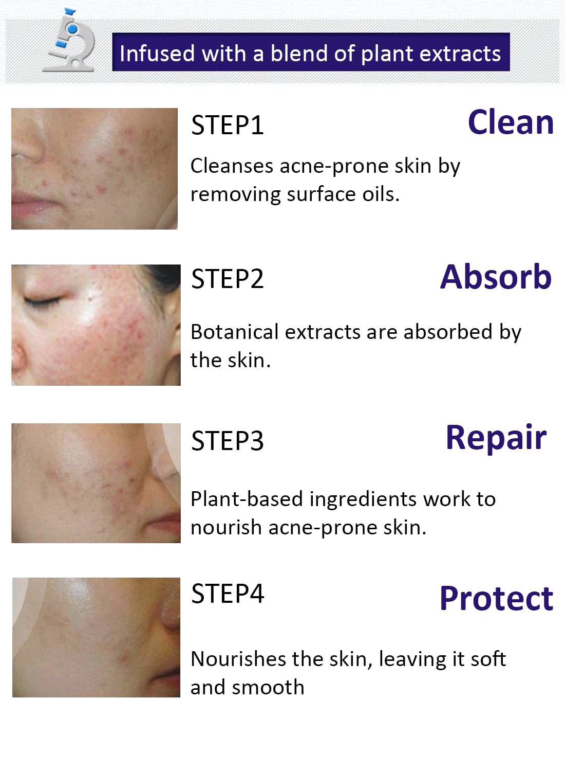 Anti-Acne Facial Treatment Cream, Gentle Face Moisturizer - 1 Pc 30g