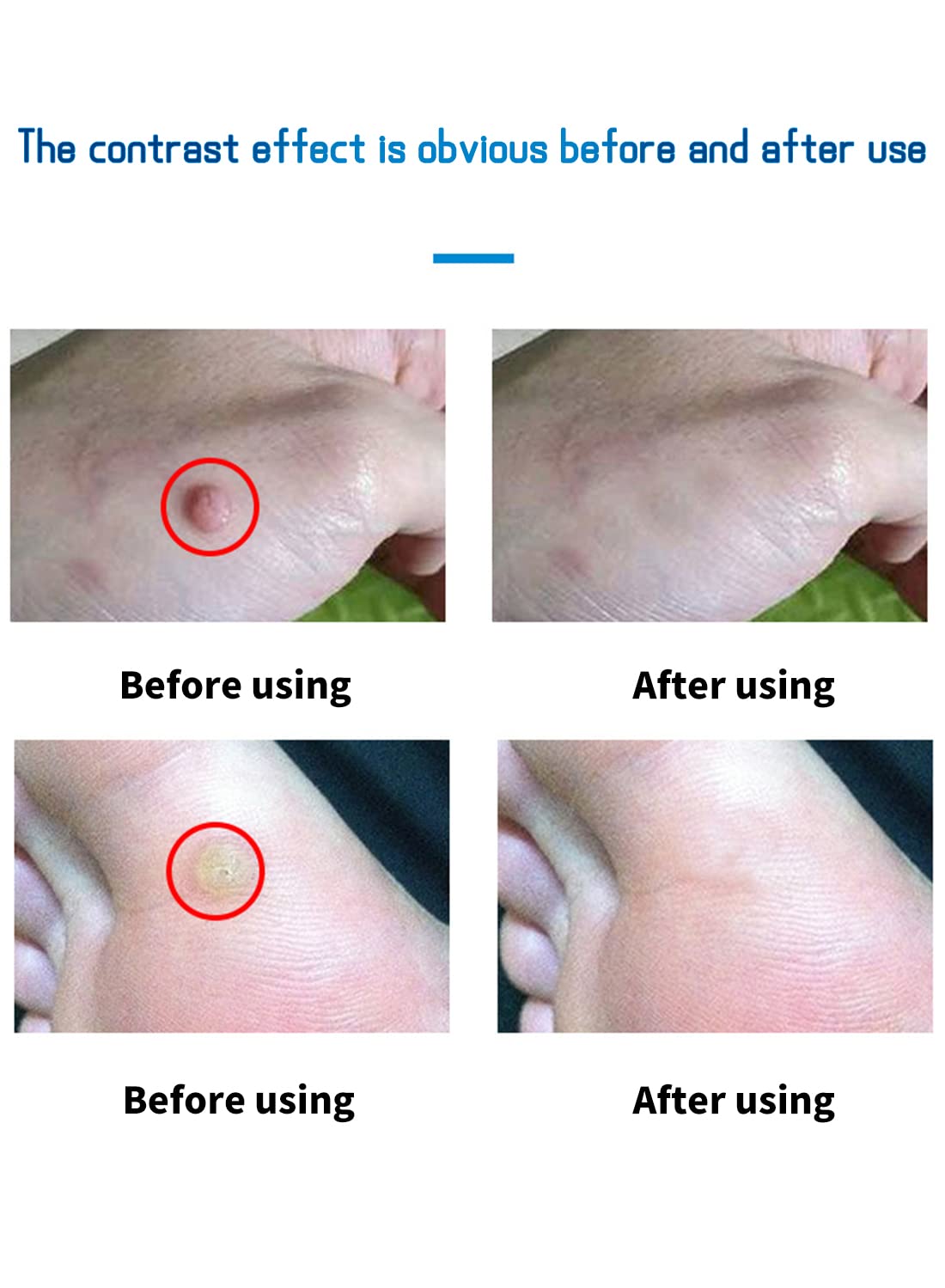 Wart Remover, Fast Acting Stop Wart Regrowth Non Irritating Wart Remover - 10ml