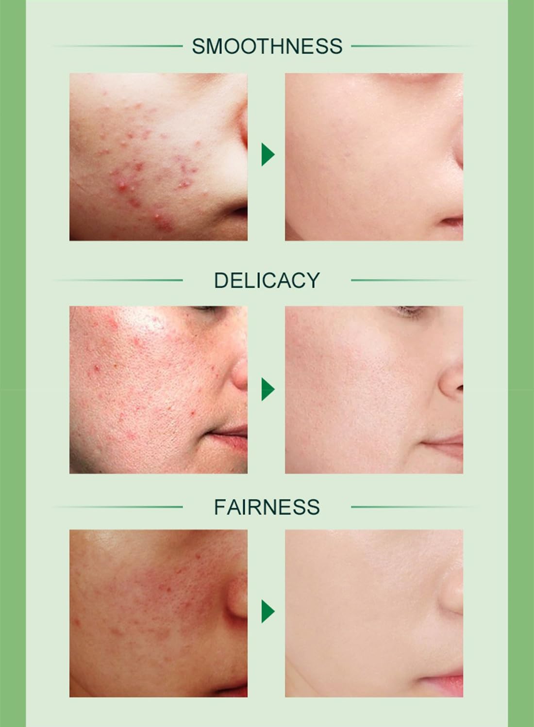 Acne Treatment Face Cream with Tea Tree Oil & Vitamin B3, Inflammation Soothing Acne Moisturizer, Acne Remover for Stubborn Pimple Blackhead Whitehead Blemish, Shrink Enlarged Pores 50g