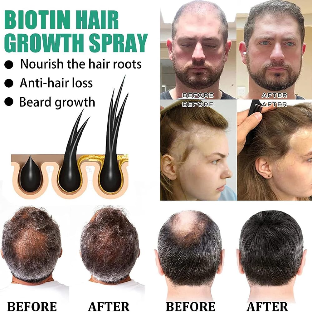 Hair Growth Serum Spray, Anti Hair Loss Hair Regrowth Treatment - 20 ml