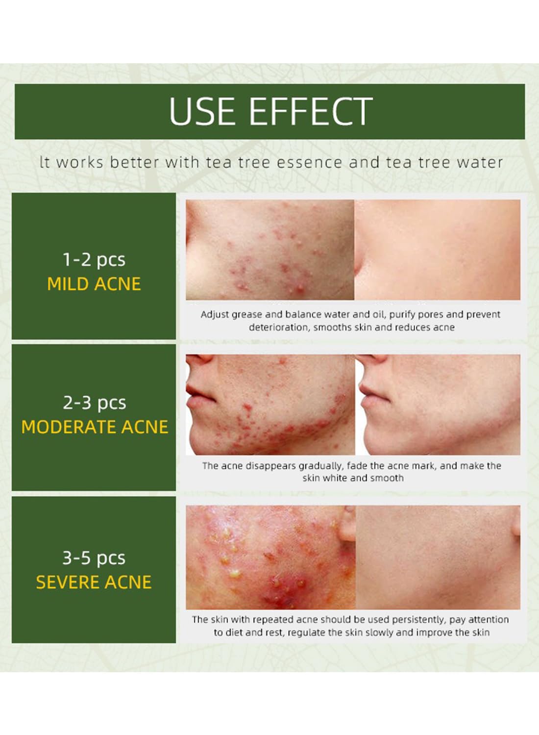 Acne Treatment Face Cream, Herbal Anti-Inflammation Soothing Acne Moisturizer with Tea Tree Oil, Acne Remover for Stubborn Pimple Blackhead Whitehead Blemish, Inflammation Relief 50g