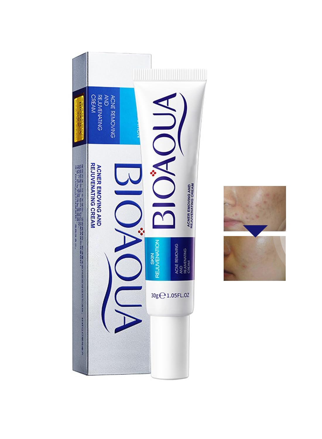 Anti-Acne Facial Treatment Cream, Gentle Face Moisturizer -  1 Pc 30g