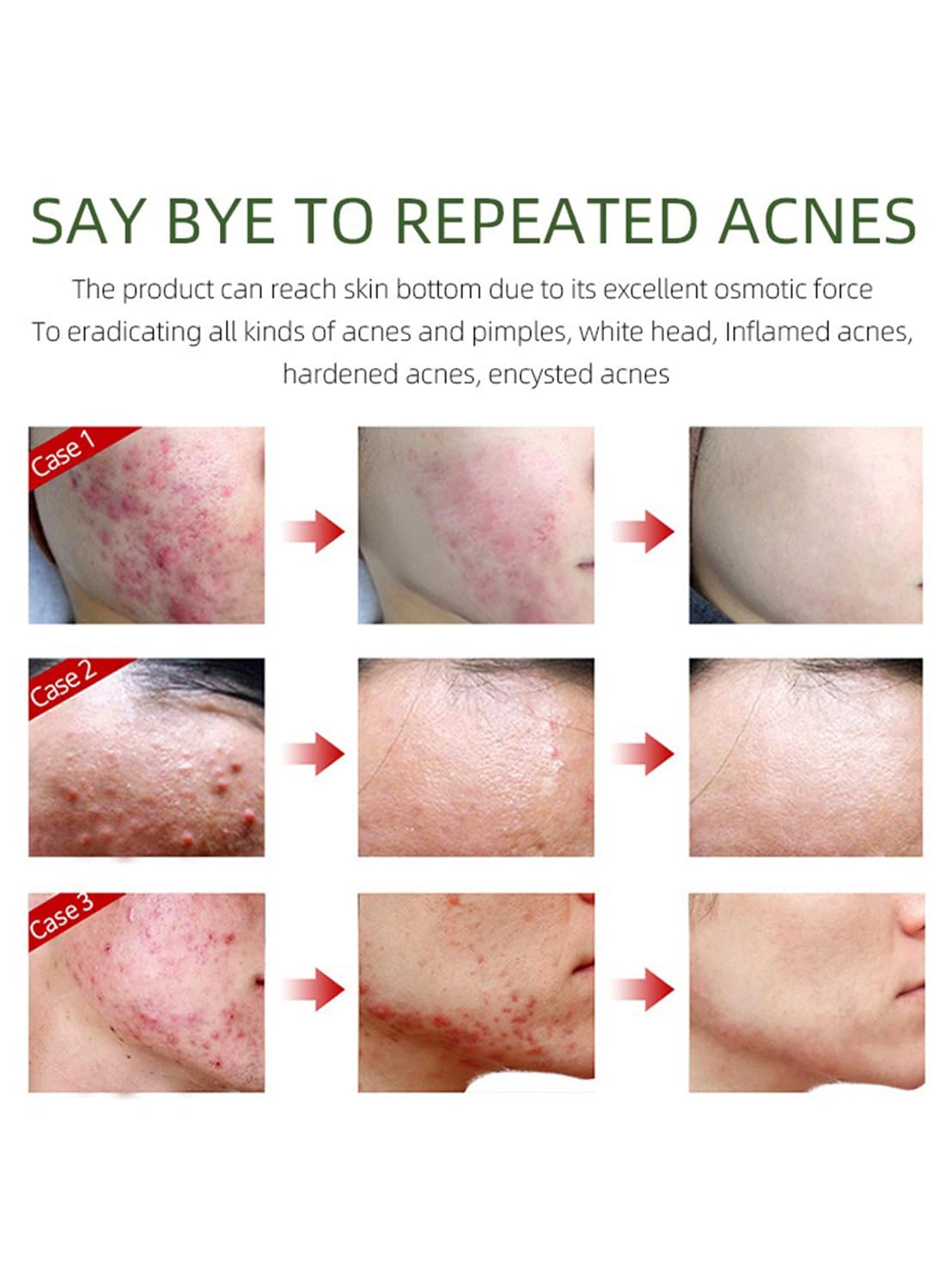 Acne Treatment Face Cream, Herbal Anti-Inflammation Soothing Acne Moisturizer with Tea Tree Oil, Acne Remover for Stubborn Pimple Blackhead Whitehead Blemish, Inflammation Relief 50g
