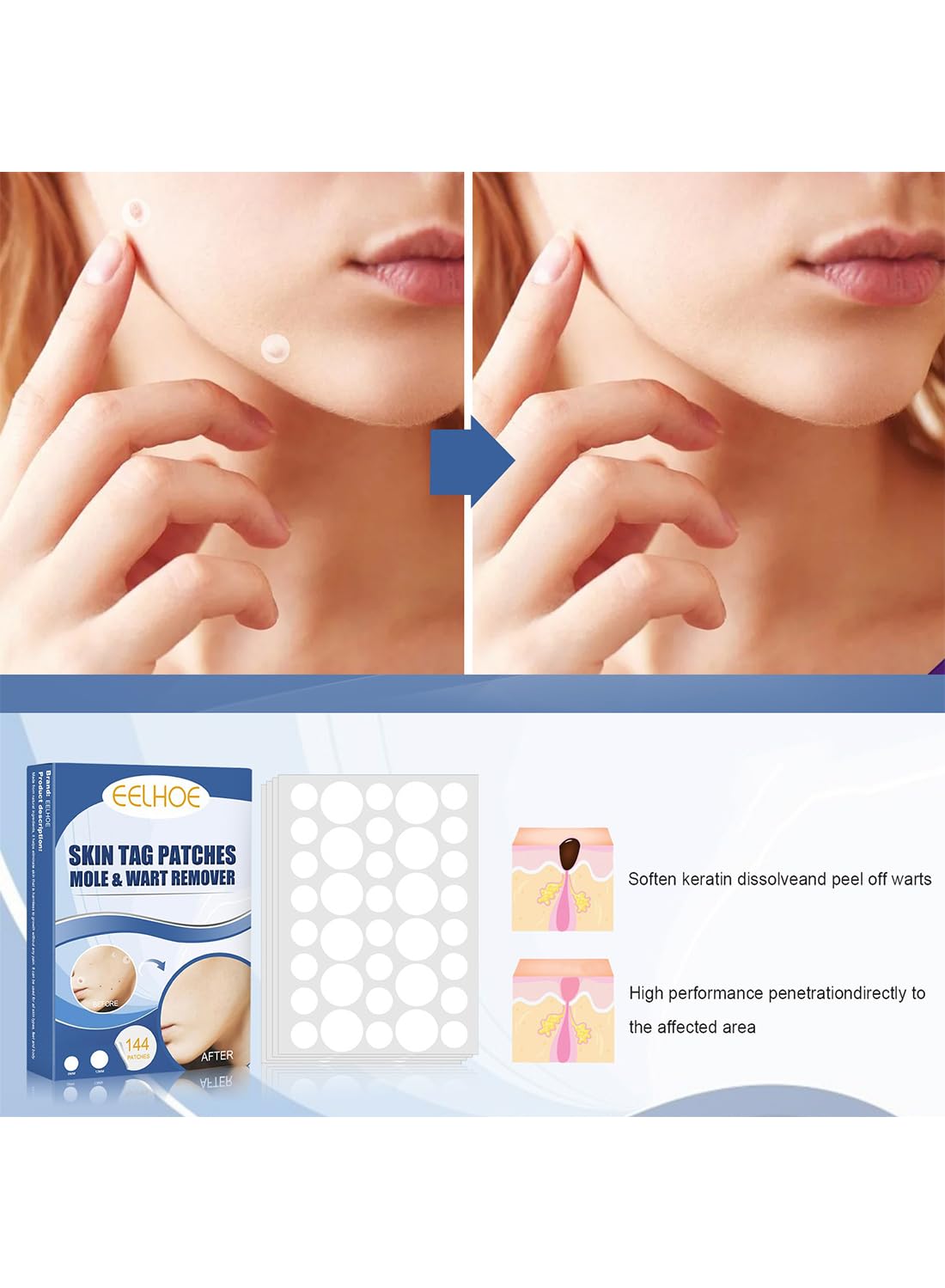 144Pcs Wart and Mole Remover, Easy-to-Use Waterproof Transparent Stickers