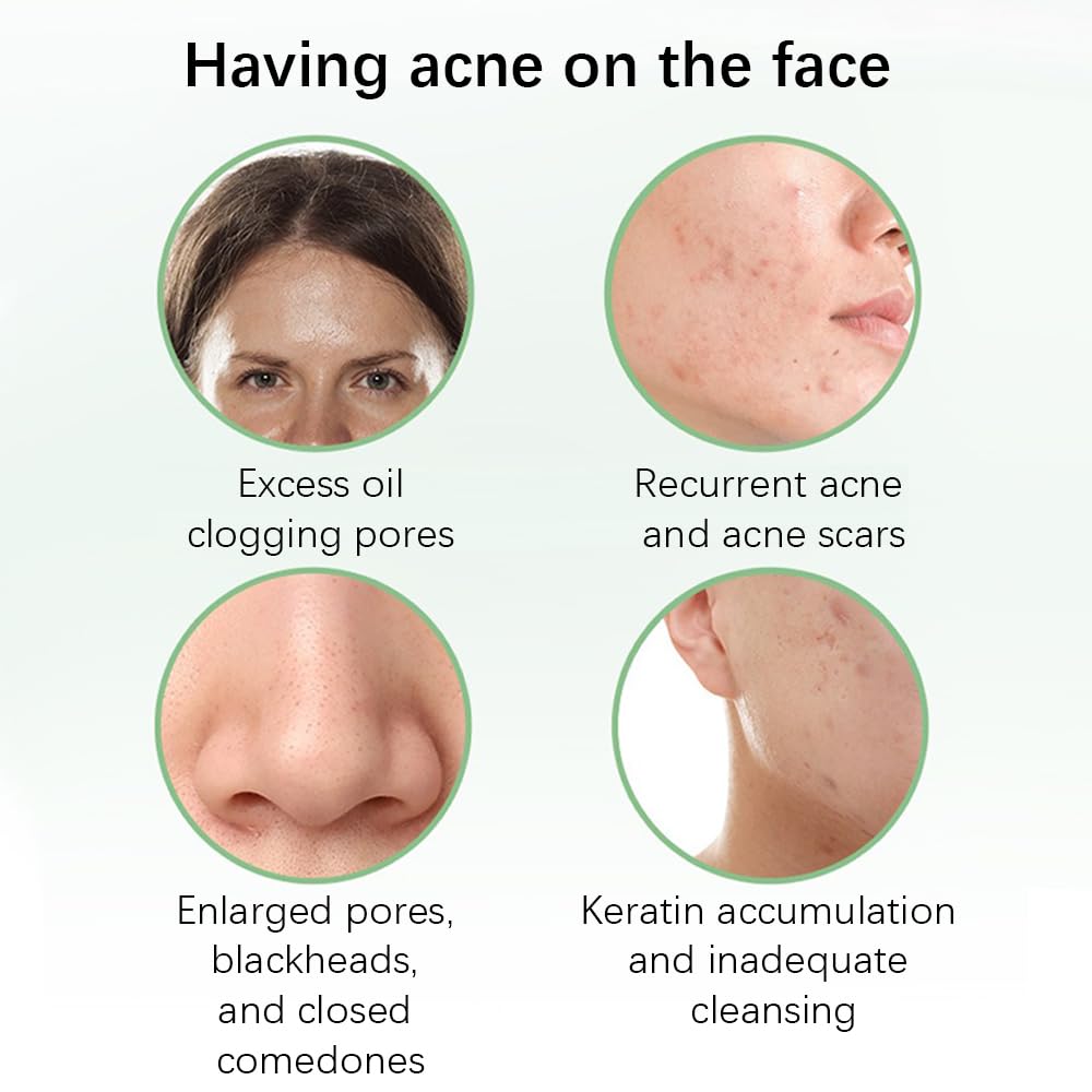 Acne Treatment for Face, Refreshing Acne Cream, Fast Active Blemish Remover