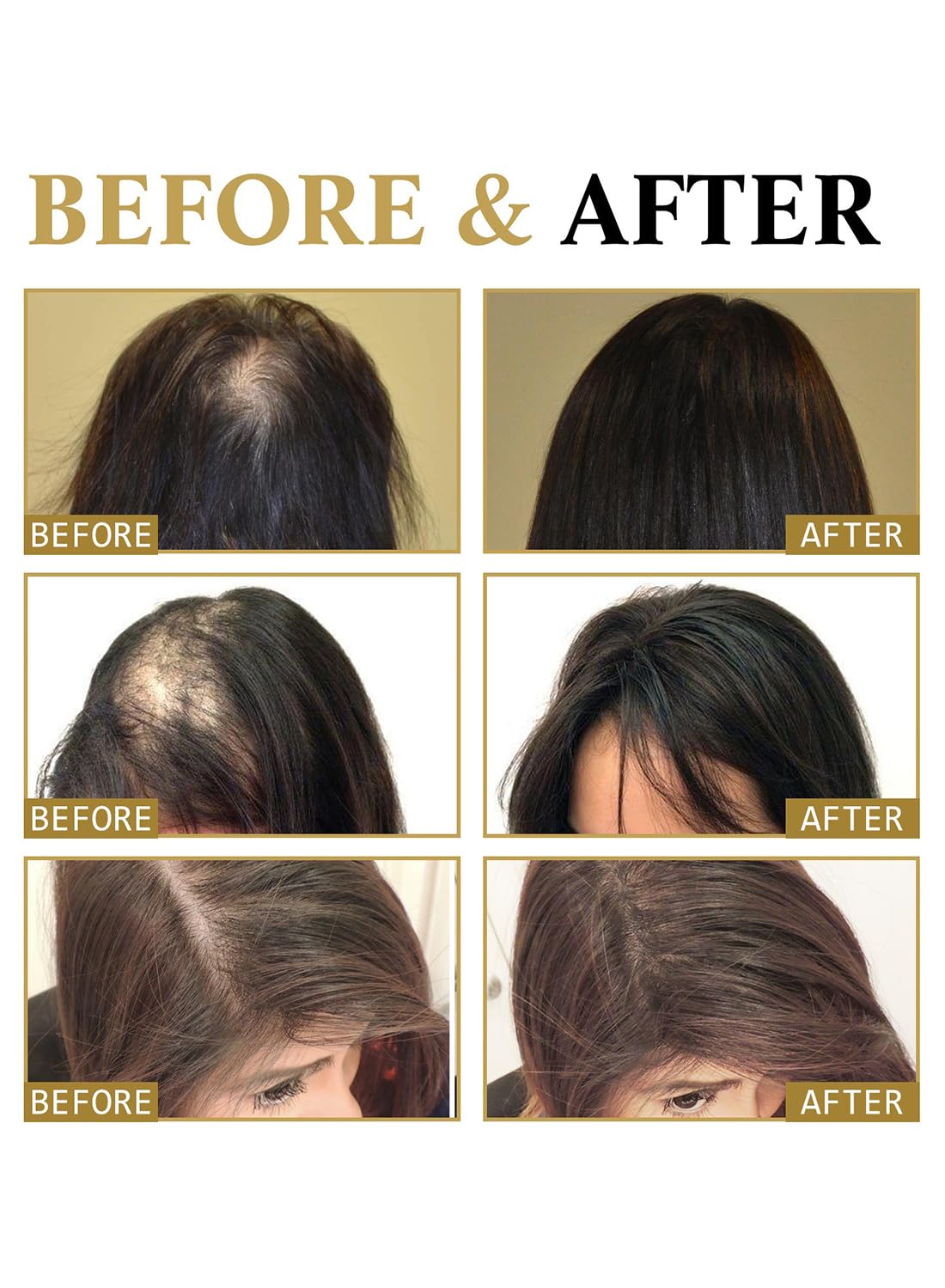 Hair Loss Treatment for Hair Growth, Anti Hair Loss Roll On Massage Hair Boost Essence, Darkens & Strengthens & Promotes Hair Circulation, Reduces Hair Loss, Restores Thin Hair 20ml