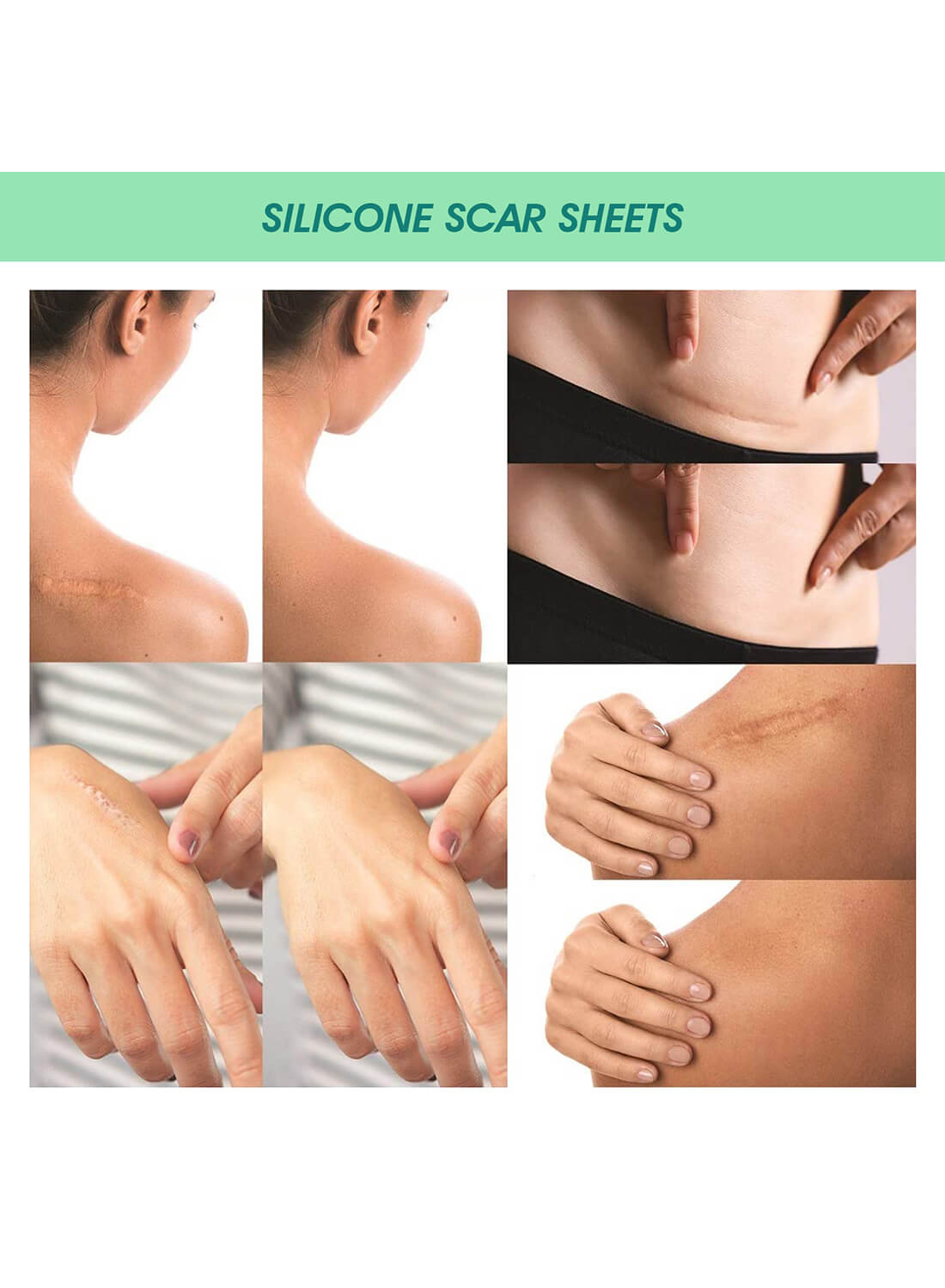 ELAIMEI Silicone Scar Sheets Skin Care 4Pcs