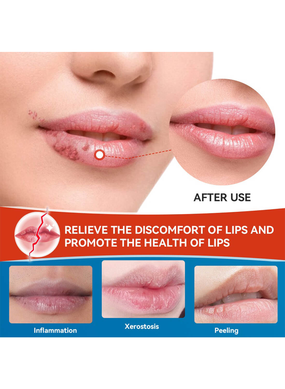 Cheilitis Cream, Lip Care for Dry Cracked Lips 20G